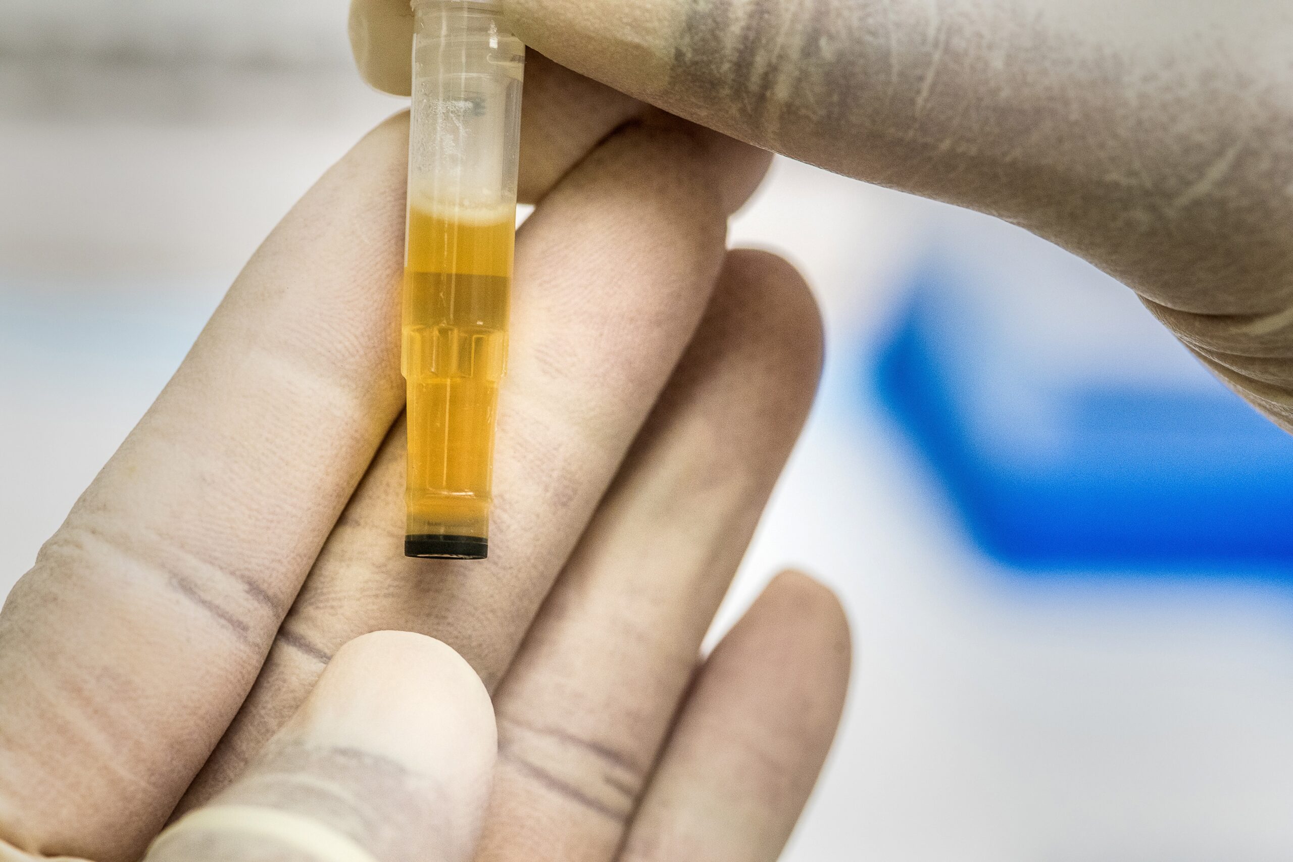 close up of a urine sample held in the hands of someone wearing latex gloves
